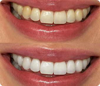 Blanchiment Dentaire™️ Sourire Éclatant
