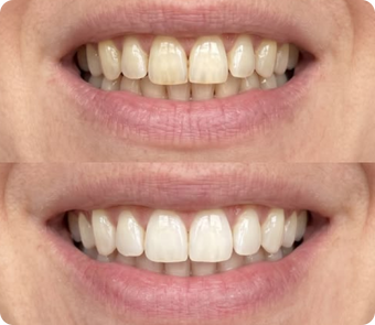 Blanchiment Dentaire™️ Sourire Éclatant